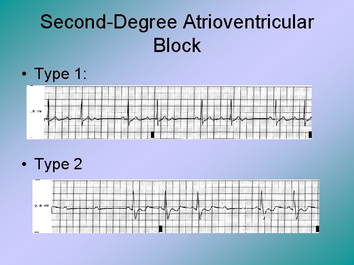 Second-Degree Atrioventricular Block • Type 1: • Type 2 