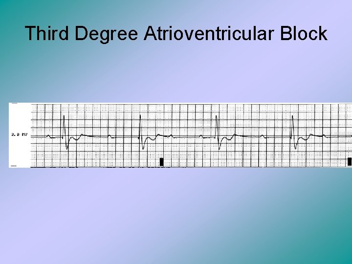 Third Degree Atrioventricular Block 