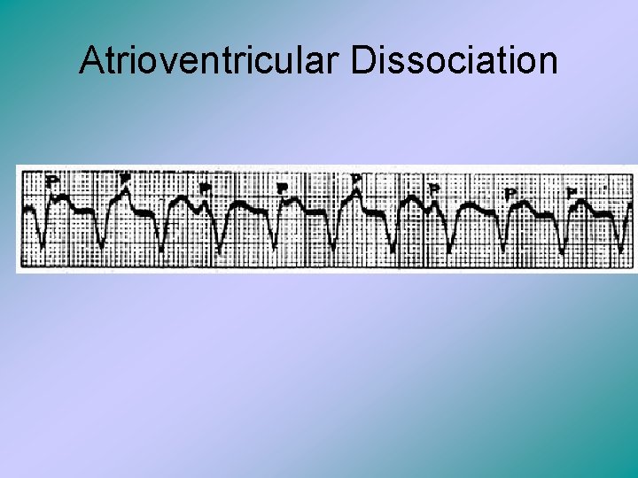 Atrioventricular Dissociation 