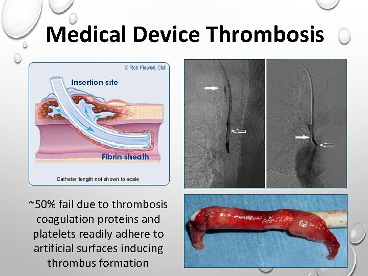 Medical Device Thrombosis ~50% fail due to thrombosis coagulation proteins and platelets readily adhere