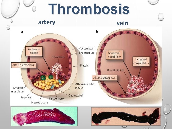 Thrombosis artery vein 