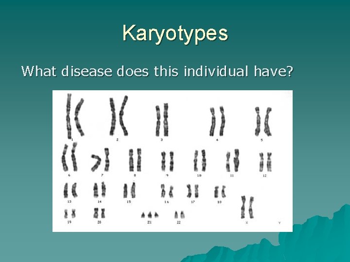 Karyotypes What disease does this individual have? 