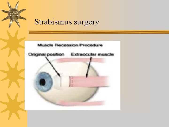 Strabismus surgery 