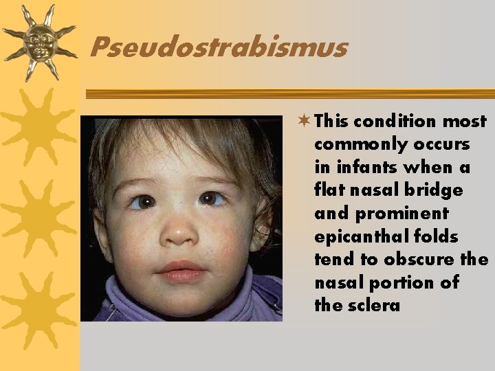 Pseudostrabismus ¬ This condition most commonly occurs in infants when a flat nasal bridge