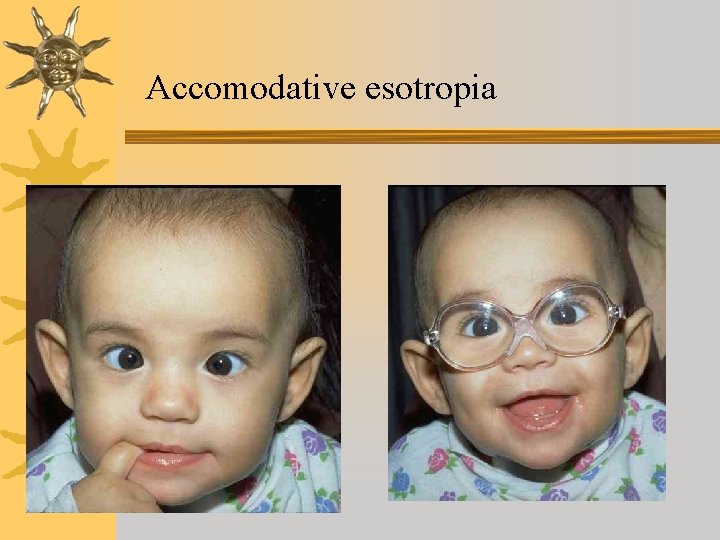Accomodative esotropia 