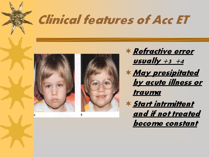 Clinical features of Acc ET ¬ Refractive error usually +3_+4 ¬ May presipitated by