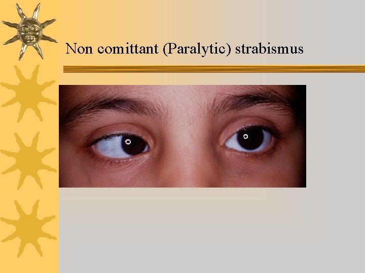 Non comittant (Paralytic) strabismus 