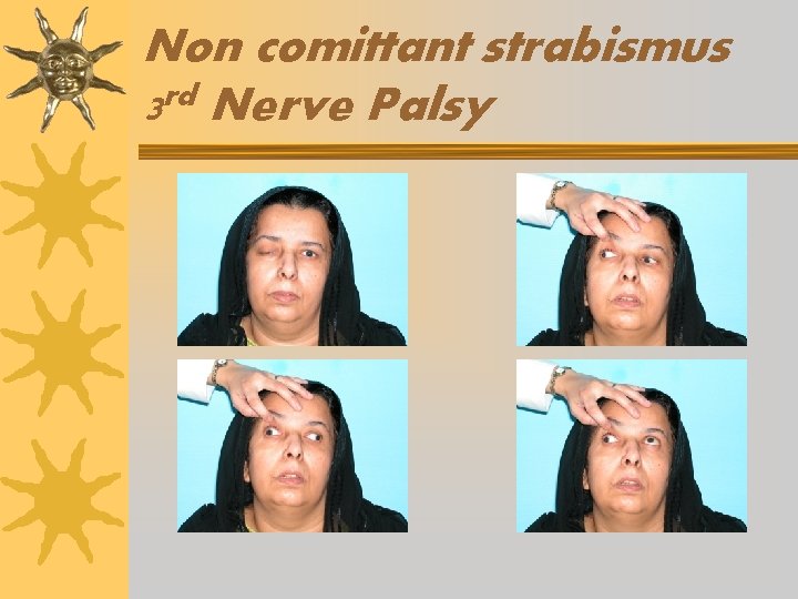 Non comittant strabismus rd 3 Nerve Palsy 