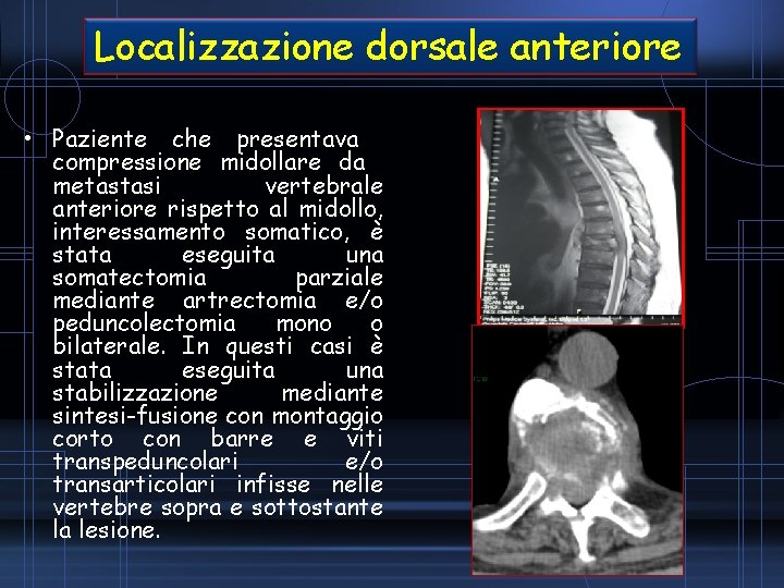 Localizzazione dorsale anteriore • Paziente che presentava compressione midollare da metastasi vertebrale anteriore rispetto