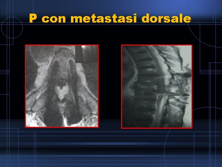 P con metastasi dorsale 