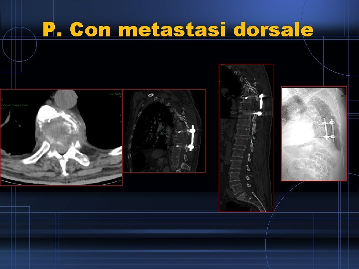 P. Con metastasi dorsale 