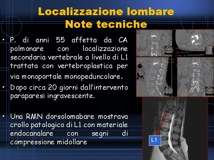 Localizzazione lombare Note tecniche • P. di anni 55 affetta da CA polmonare con