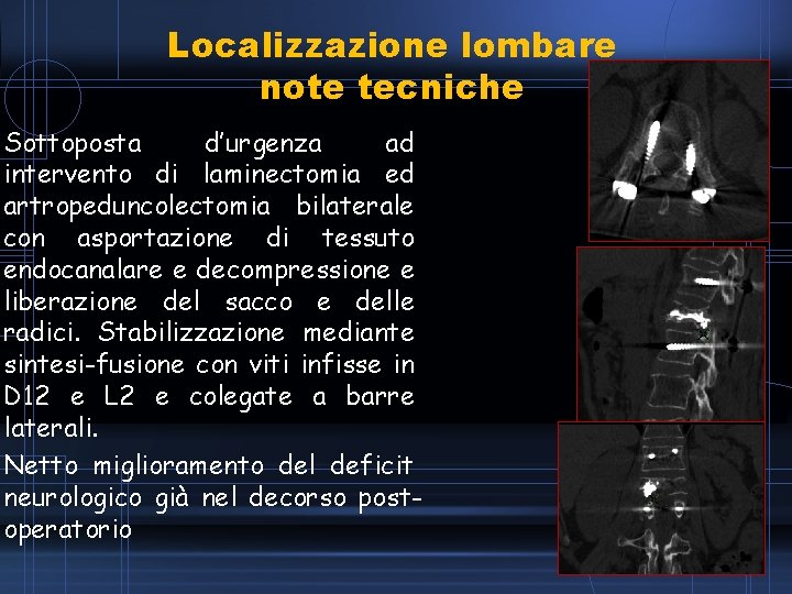 Localizzazione lombare note tecniche Sottoposta d’urgenza ad intervento di laminectomia ed artropeduncolectomia bilaterale con