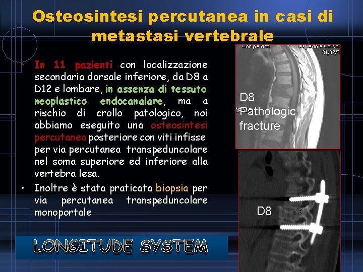 Osteosintesi percutanea in casi di metastasi vertebrale • In 11 pazienti con localizzazione secondaria