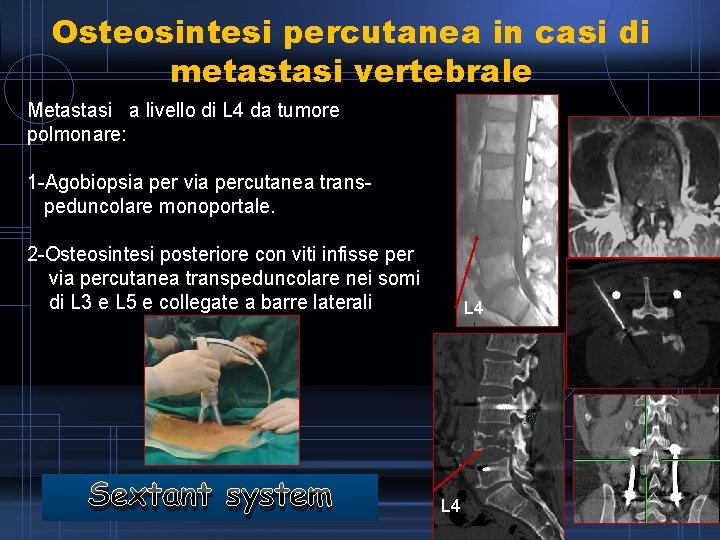 Osteosintesi percutanea in casi di metastasi vertebrale Metastasi a livello di L 4 da