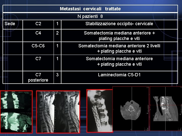 Metastasi cervicali trattate N pazienti 8 Sede C 2 1 Stabilizzazione occipito- cervicale C