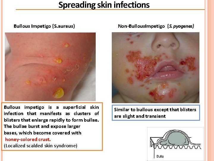 Spreading skin infections Bullous Impetigo (S. aureus) Bullous impetigo is a superficial skin infection Spreading skin infections Bullous Impetigo (S. aureus) Bullous impetigo is a superficial skin infection