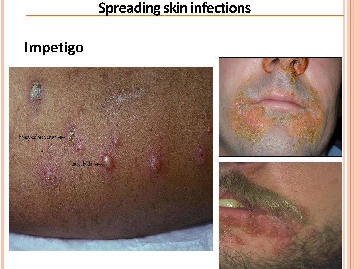 Spreading skin infections Impetigo  Spreading skin infections Impetigo