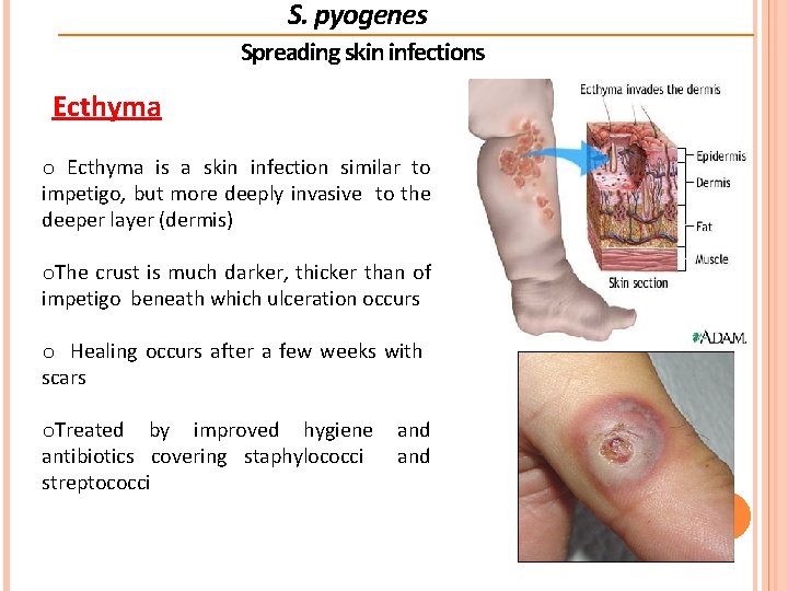 S. pyogenes Spreading skin infections Ecthyma o Ecthyma is a skin infection similar to S. pyogenes Spreading skin infections Ecthyma o Ecthyma is a skin infection similar to