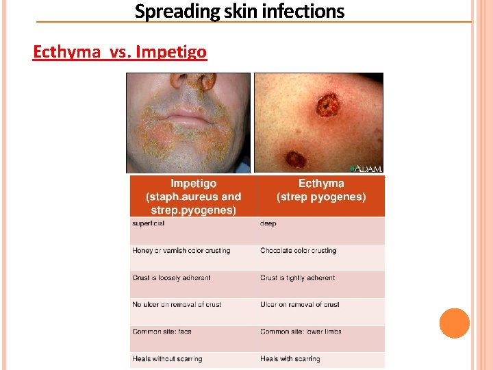 Spreading skin infections Ecthyma vs. Impetigo  Spreading skin infections Ecthyma vs. Impetigo