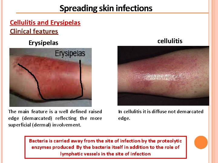 Spreading skin infections Cellulitis and Erysipelas Clinical features Erysipelas The main feature is a Spreading skin infections Cellulitis and Erysipelas Clinical features Erysipelas The main feature is a