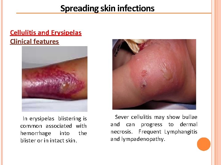 Spreading skin infections Cellulitis and Erysipelas Clinical features In erysipelas blistering is common associated Spreading skin infections Cellulitis and Erysipelas Clinical features In erysipelas blistering is common associated