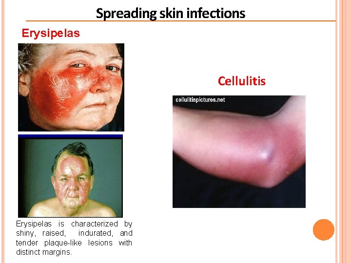 Spreading skin infections Erysipelas Cellulitis Erysipelas is characterized by shiny, raised, indurated, and tender Spreading skin infections Erysipelas Cellulitis Erysipelas is characterized by shiny, raised, indurated, and tender