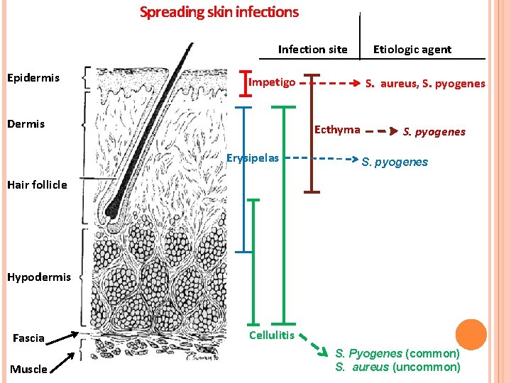 Spreading skin infections Infection site Epidermis Impetigo Dermis S. aureus, S. pyogenes Ecthyma Erysipelas Spreading skin infections Infection site Epidermis Impetigo Dermis S. aureus, S. pyogenes Ecthyma Erysipelas