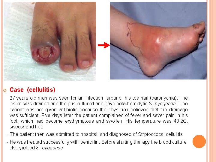Case (cellulitis) 27 years old man was seen for an infection around his  Case (cellulitis) 27 years old man was seen for an infection around his