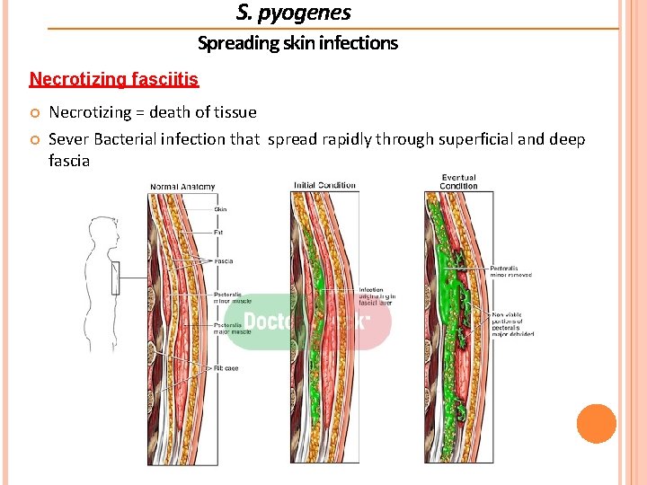 S. pyogenes Spreading skin infections Necrotizing fasciitis Necrotizing = death of tissue Sever Bacterial S. pyogenes Spreading skin infections Necrotizing fasciitis Necrotizing = death of tissue Sever Bacterial
