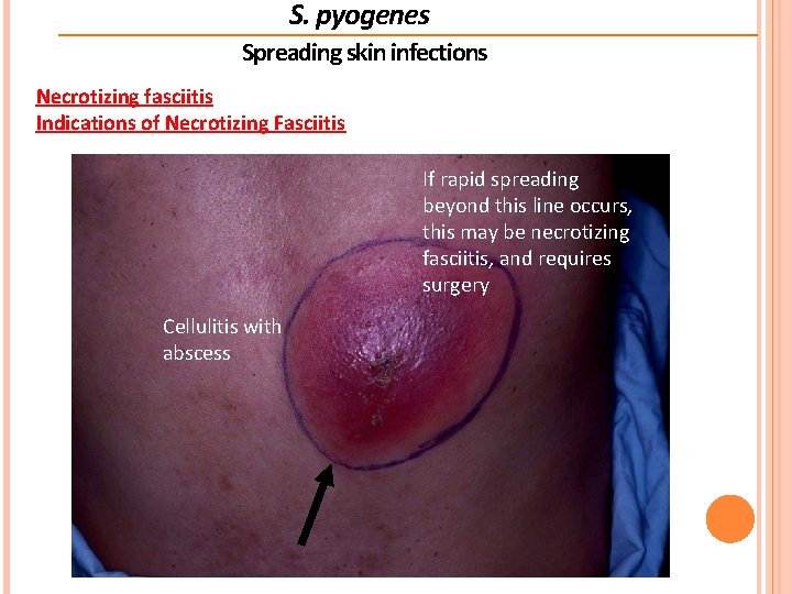S. pyogenes Spreading skin infections Necrotizing fasciitis Indications of Necrotizing Fasciitis If rapid spreading S. pyogenes Spreading skin infections Necrotizing fasciitis Indications of Necrotizing Fasciitis If rapid spreading