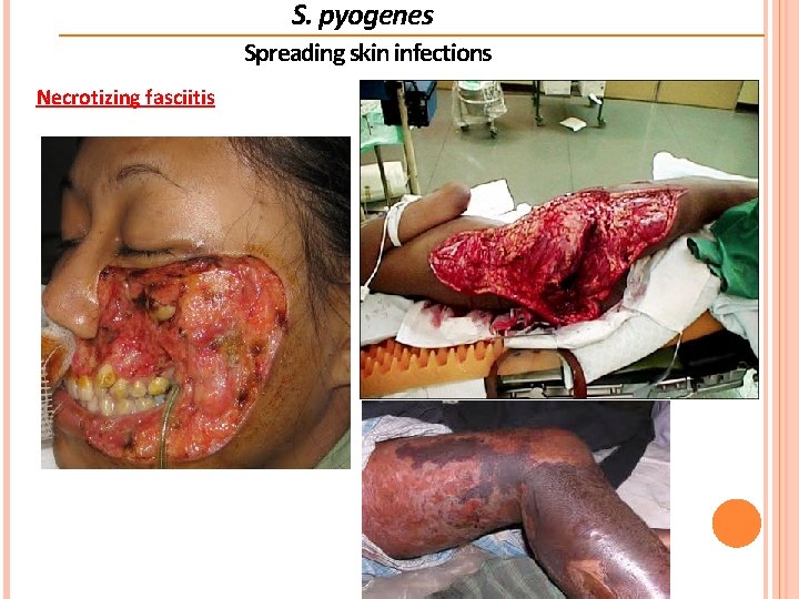 S. pyogenes Spreading skin infections Necrotizing fasciitis  S. pyogenes Spreading skin infections Necrotizing fasciitis