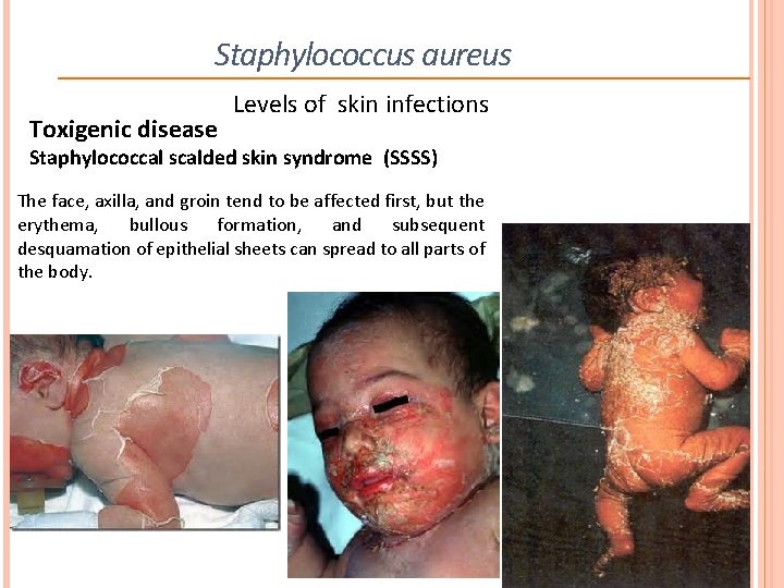 Staphylococcus aureus Toxigenic disease Levels of skin infections Staphylococcal scalded skin syndrome (SSSS) The Staphylococcus aureus Toxigenic disease Levels of skin infections Staphylococcal scalded skin syndrome (SSSS) The