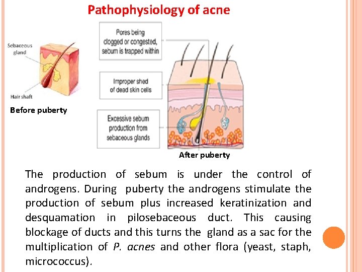 Pathophysiology of acne Before puberty After puberty The production of sebum is under the Pathophysiology of acne Before puberty After puberty The production of sebum is under the