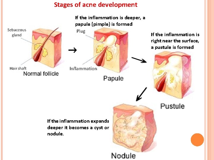 Stages of acne development If the inflammation is deeper, a papule (pimple) is formed Stages of acne development If the inflammation is deeper, a papule (pimple) is formed