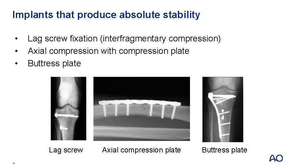 Implants that produce absolute stability • • • Lag screw fixation (interfragmentary compression) Axial