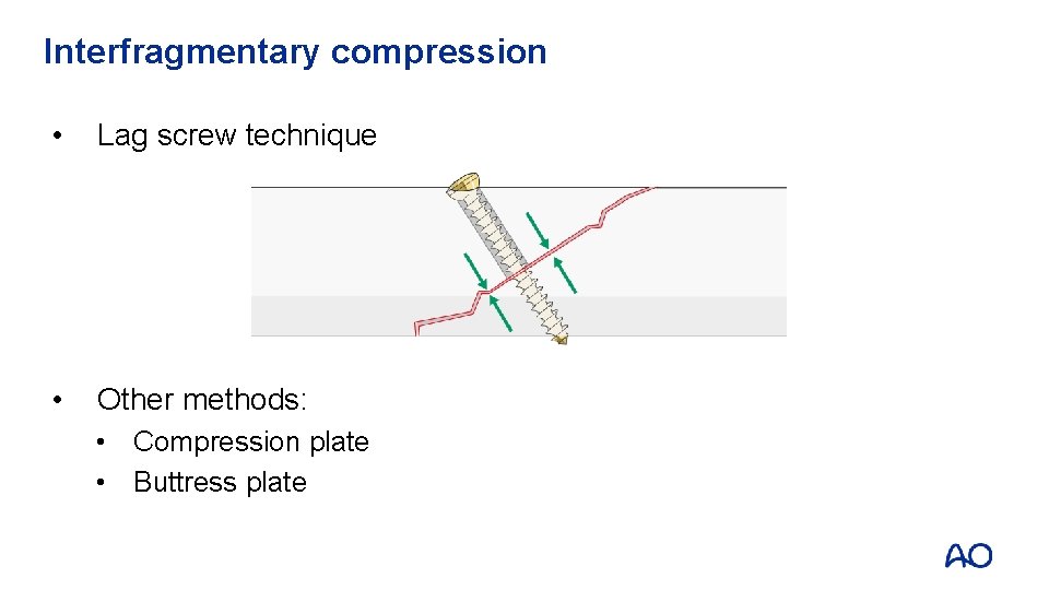 Interfragmentary compression • Lag screw technique • Other methods: • Compression plate • Buttress