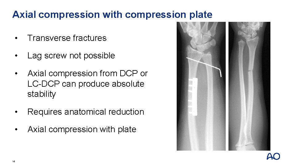 Axial compression with compression plate • Transverse fractures • Lag screw not possible •