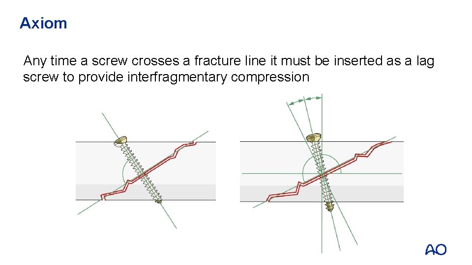 Axiom Any time a screw crosses a fracture line it must be inserted as