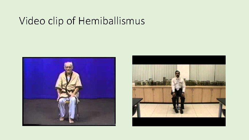 Video clip of Hemiballismus 