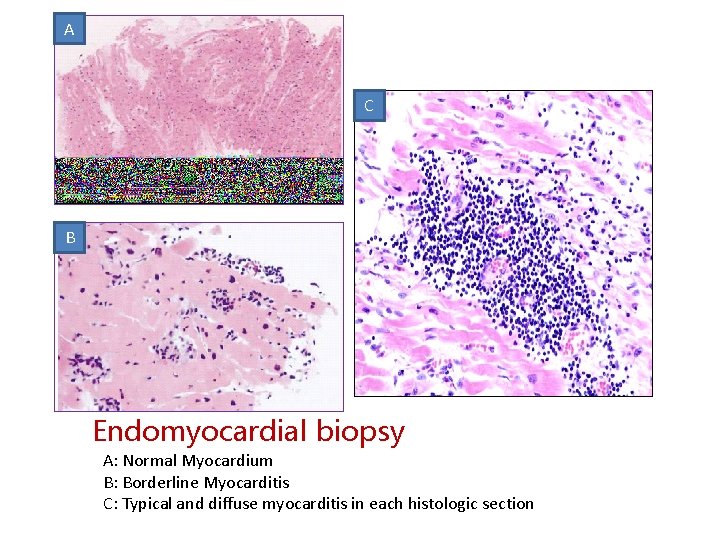 A C B Endomyocardial biopsy A: Normal Myocardium B: Borderline Myocarditis C: Typical and
