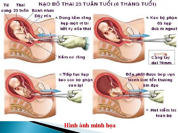 Hình ảnh minh họa 