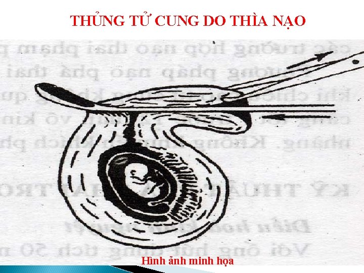 THỦNG TỬ CUNG DO THÌA NẠO Hình ảnh minh họa 