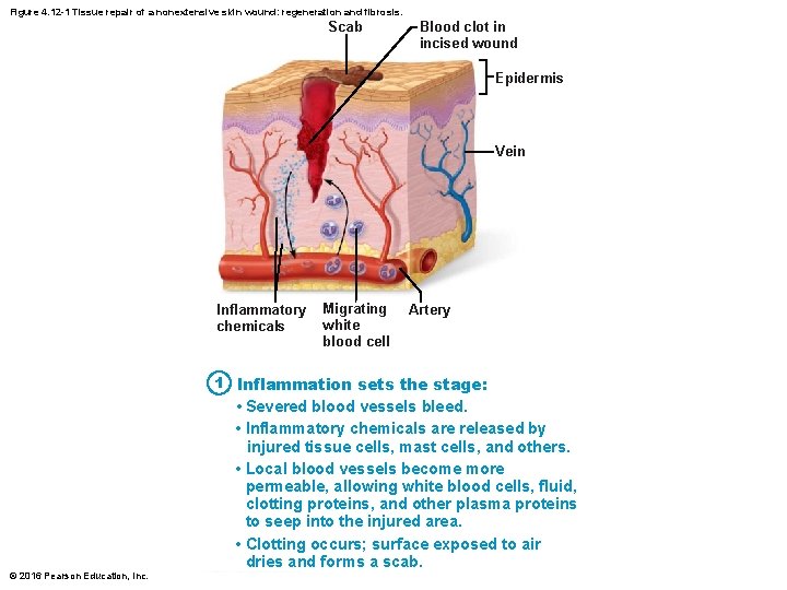 Figure 4. 12 -1 Tissue repair of a nonextensive skin wound: regeneration and fibrosis.