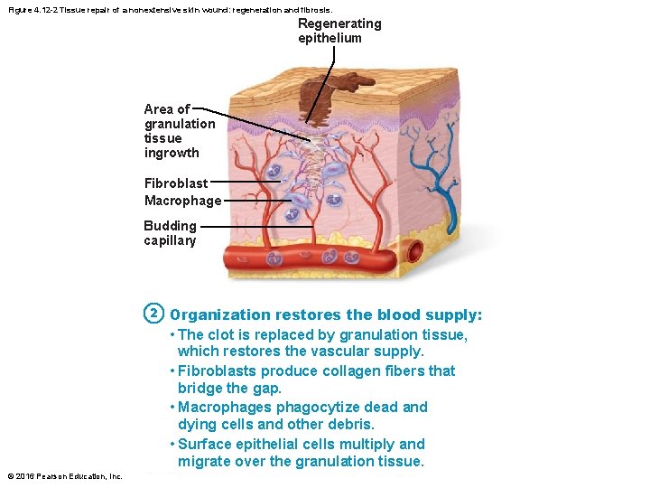 Figure 4. 12 -2 Tissue repair of a nonextensive skin wound: regeneration and fibrosis.