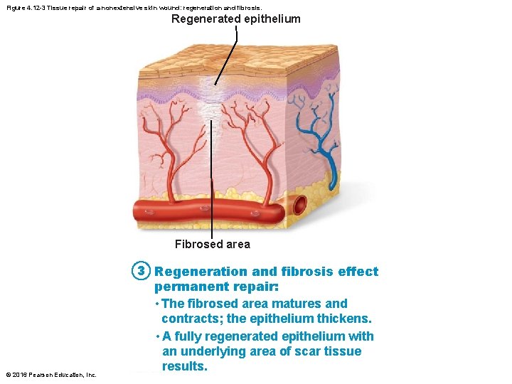Figure 4. 12 -3 Tissue repair of a nonextensive skin wound: regeneration and fibrosis.