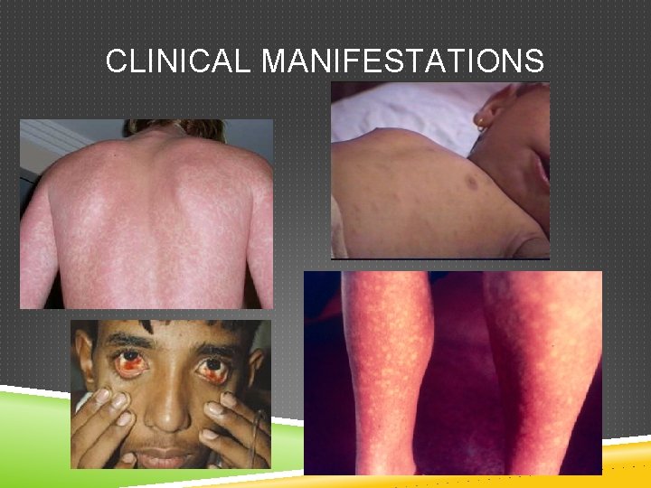 CLINICAL MANIFESTATIONS CLINICAL MANIFESTATIONS