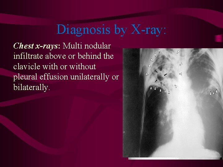 Diagnosis by X-ray: Chest x-rays: Multi nodular infiltrate above or behind the clavicle with