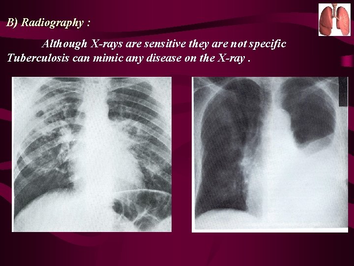 B) Radiography : Although X-rays are sensitive they are not specific Tuberculosis can mimic