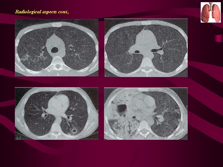 Radiological aspects cont. , 